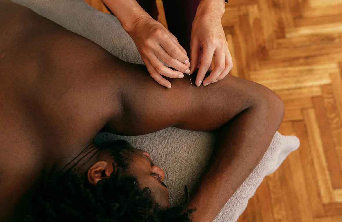 Acupuncture